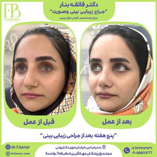 جراحی-بینی-در-بندرعباس-243