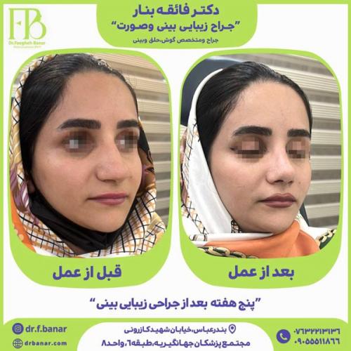 جراحی-بینی-در-بندرعباس-244