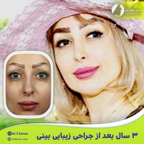 جراحی-بینی-در-بندرعباس219