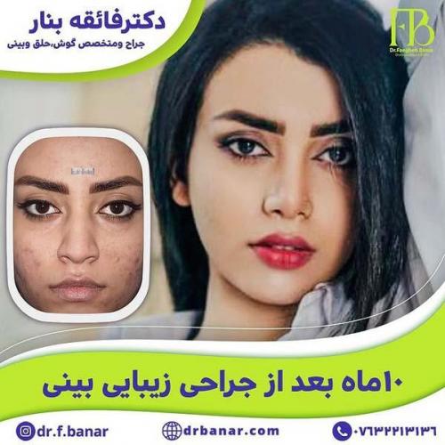 جراحی-بینی-در-بندرعباس220