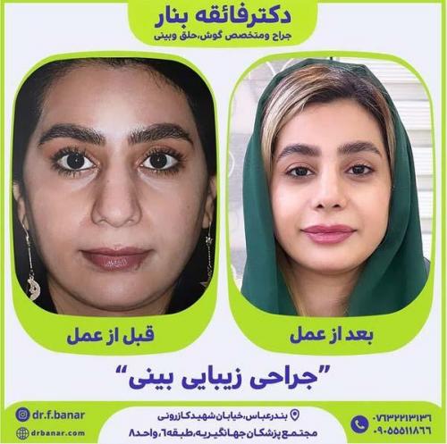 جراحی-بینی-در-بندرعباس221