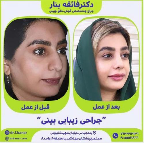 جراحی-بینی-در-بندرعباس222