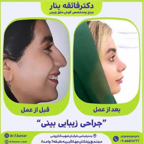 جراحی-بینی-در-بندرعباس223