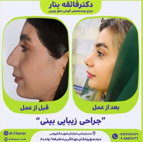 جراحی-بینی-در-بندرعباس224