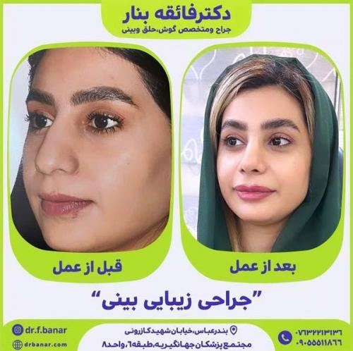 جراحی-بینی-در-بندرعباس225