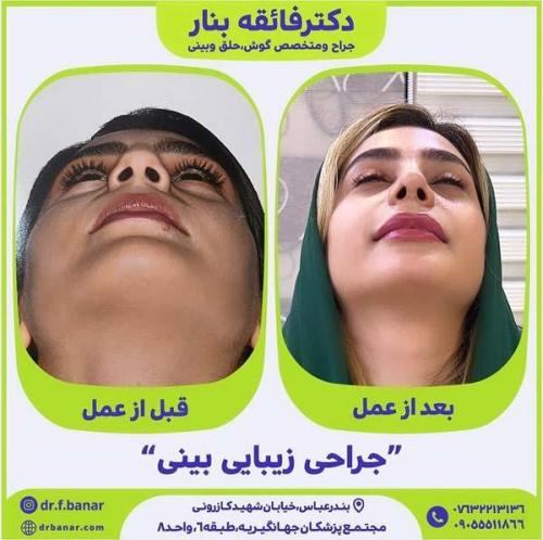 جراحی-بینی-در-بندرعباس226