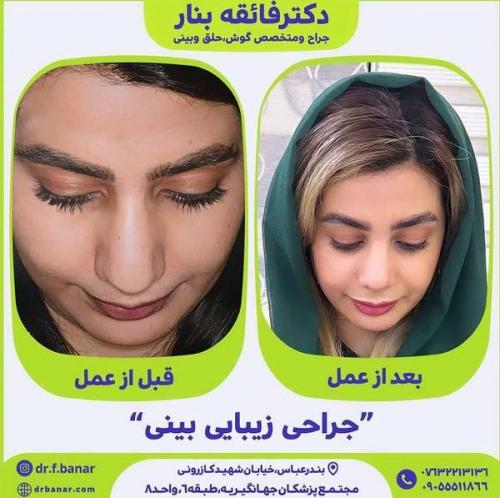 جراحی-بینی-در-بندرعباس227