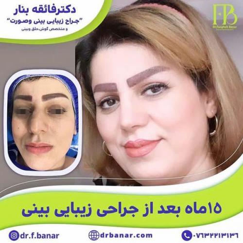 جراحی-بینی-در-بندرعباس228