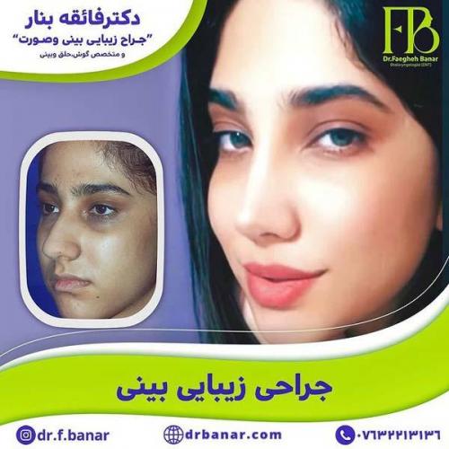 جراحی-بینی-در-بندرعباس229