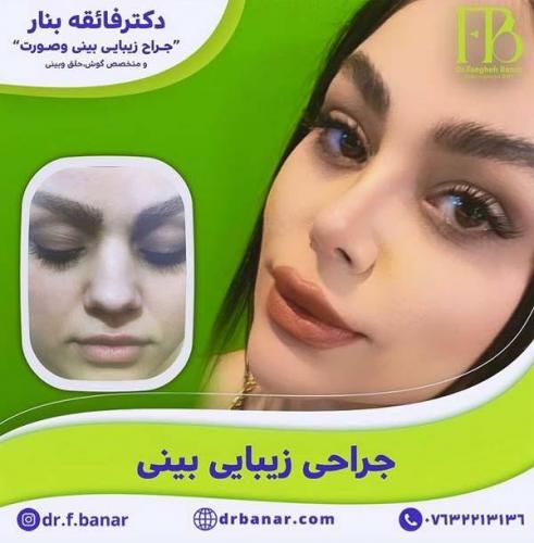 جراحی-بینی-در-بندرعباس231