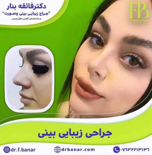 جراحی-بینی-در-بندرعباس232