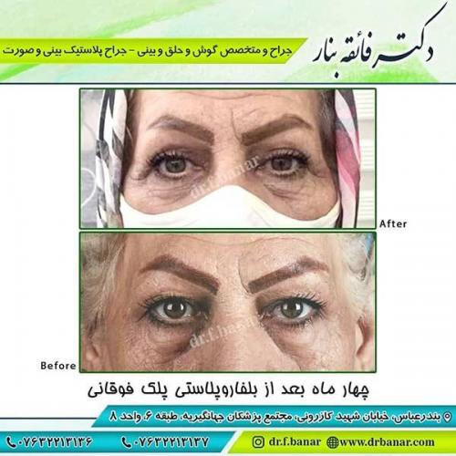 جراحی-پلک-1