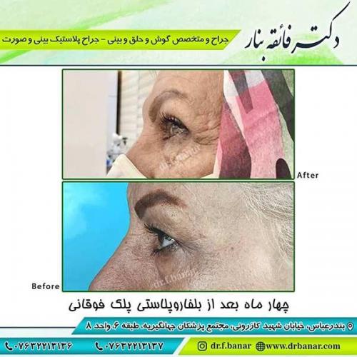 جراحی-پلک-2