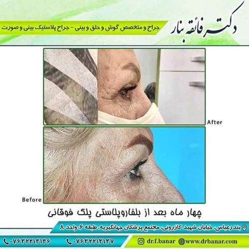 جراحی-پلک-3