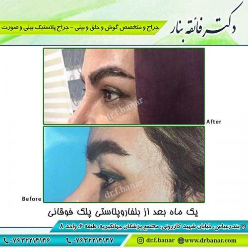 جراحی-پلک-4