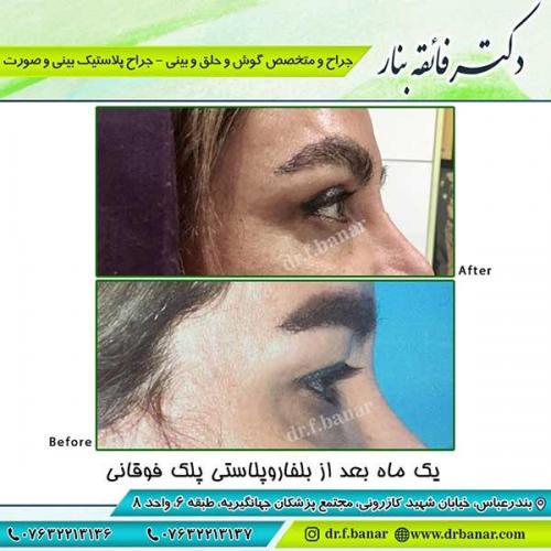 جراحی-پلک-5