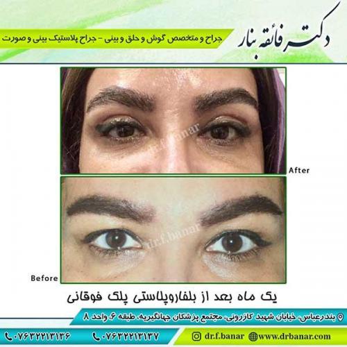 جراحی-پلک-7