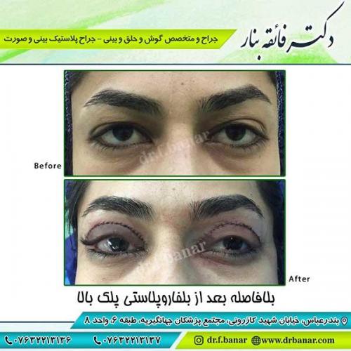 جراحی-پلک-بندرعباس-1