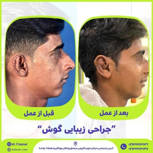 جراحی-گوش-14