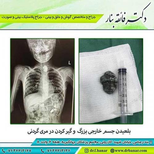 بلعیدن-جسم-خارجی-و-گیر-کردن-در-مرد-گردنی-2