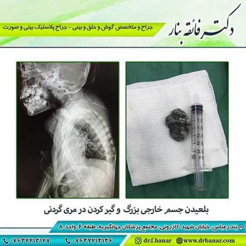 بلعیدن-جسم-خارجی-و-گیر-کردن-در-مرد-گردنی
