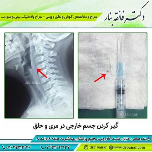 گیر-کردن-جسم-خارجی-در-مری-و-حلق